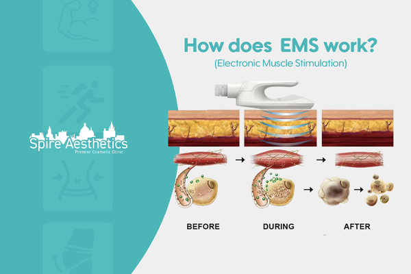 EMS treatment for post pregnancy weight loss treatment Shropshire