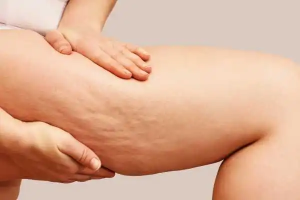 Image of woman showing leg with cellulite Shropshire