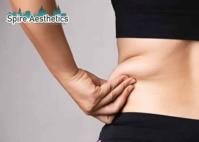 Image of woman pinching fat on their hips Shropshire . Fat Freezing treatment