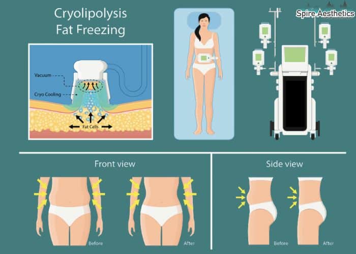 Image of diet and fat freezing combined for best results for Spire Aesthetics Shropshire