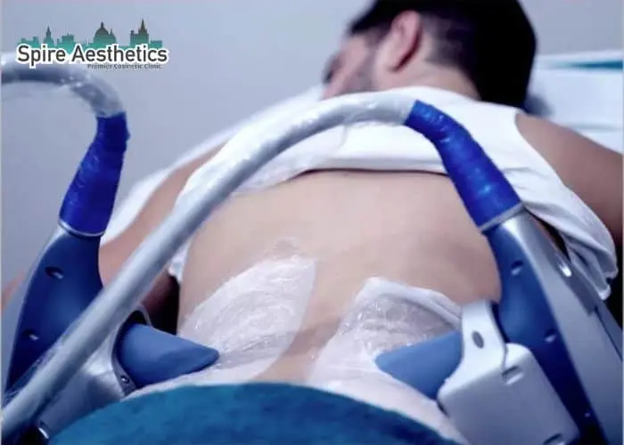 Man having fat freezing treatment done on love handles before a competitions Shropshire to create a sculpted look.