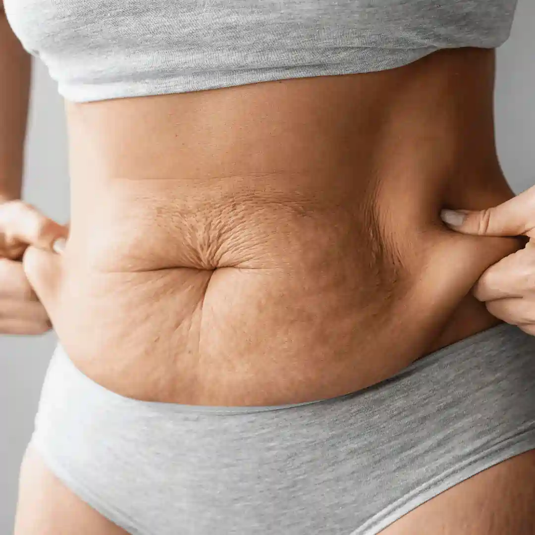 Is It Normal to Have Loose Skin After Pregnancy Shropshire ?