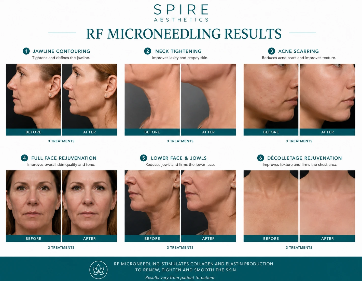 RF Microneedling Skin tightening Shropshire results