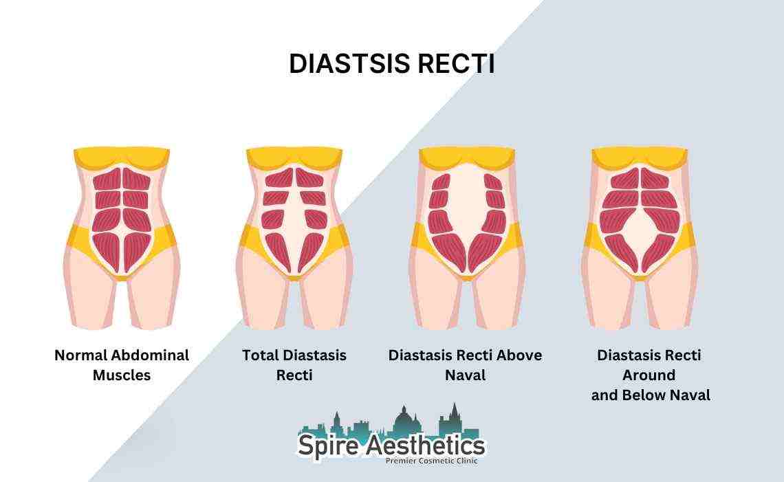 Is Non-Surgical Diastasis Recti Treatment Right for You? Common Concerns Answered Shropshire